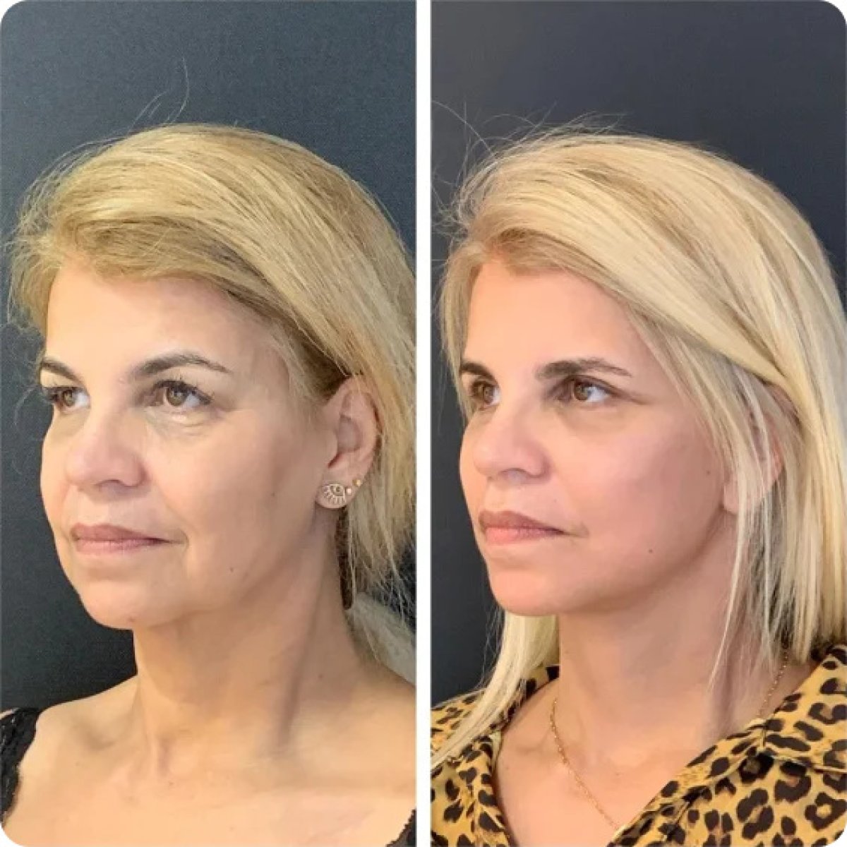 Facelift before and after results – visible facial rejuvenation and tighter jawline
