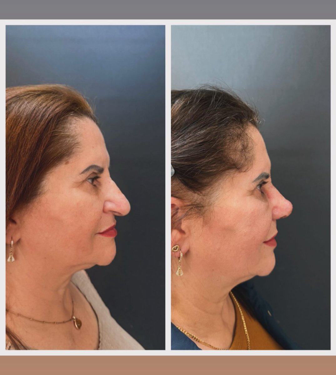 نتائج عملية تجميل الأنف قبل وبعد، إعادة تشكيل الأنف لتحسين المظهر والتناسق