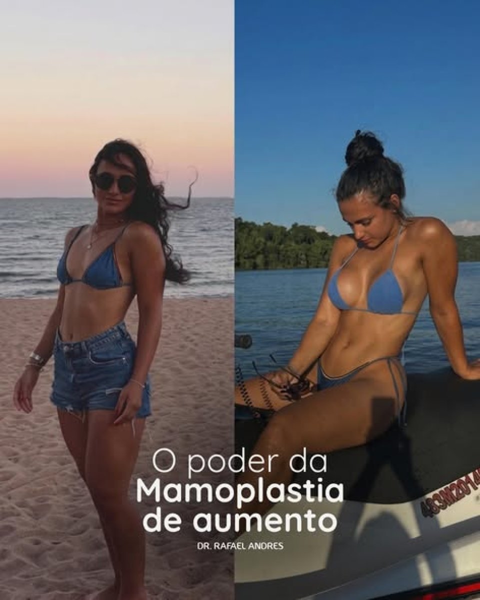 Resultados de mamoplastia de aumento antes y después por el Dr. Rafael Andres