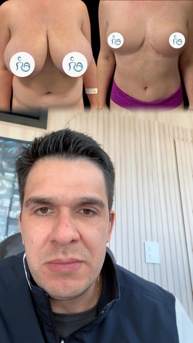 Resultados antes y después de mamoplastia, levantamiento y remodelación mamaria en la clínica