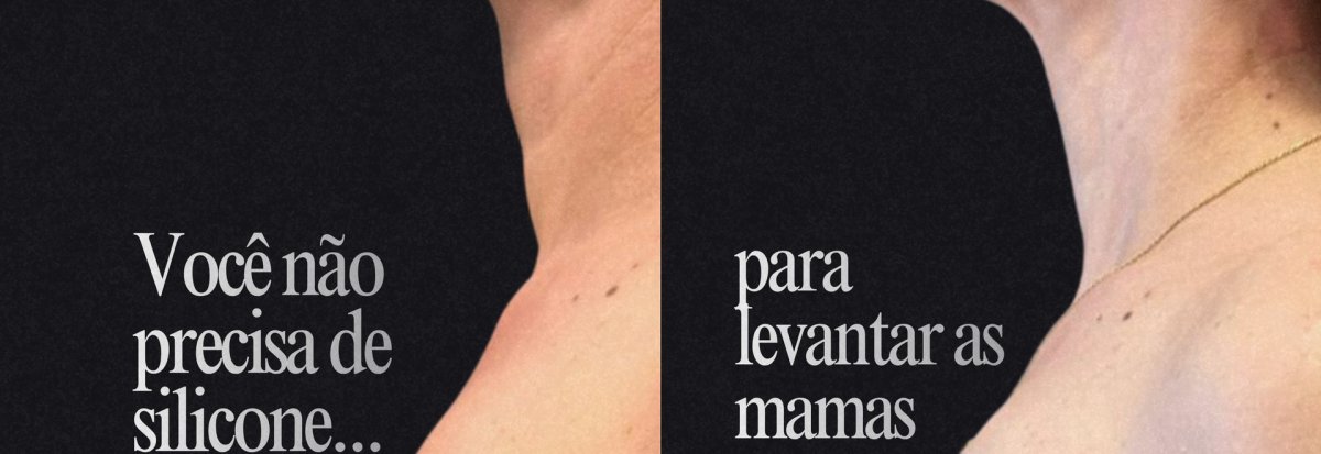 Resultados antes y después de mastopexia – mejora del contorno sin implantes