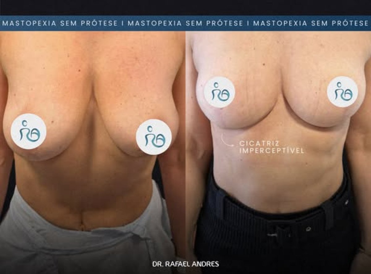 Resultados de lifting de senos sin implantes antes y después en la clínica Dr. Rafael Andres