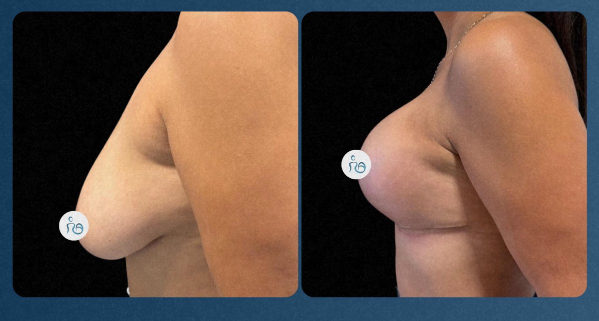 Resultados de lifting de senos antes y después – mejor forma y contorno tras cirugía