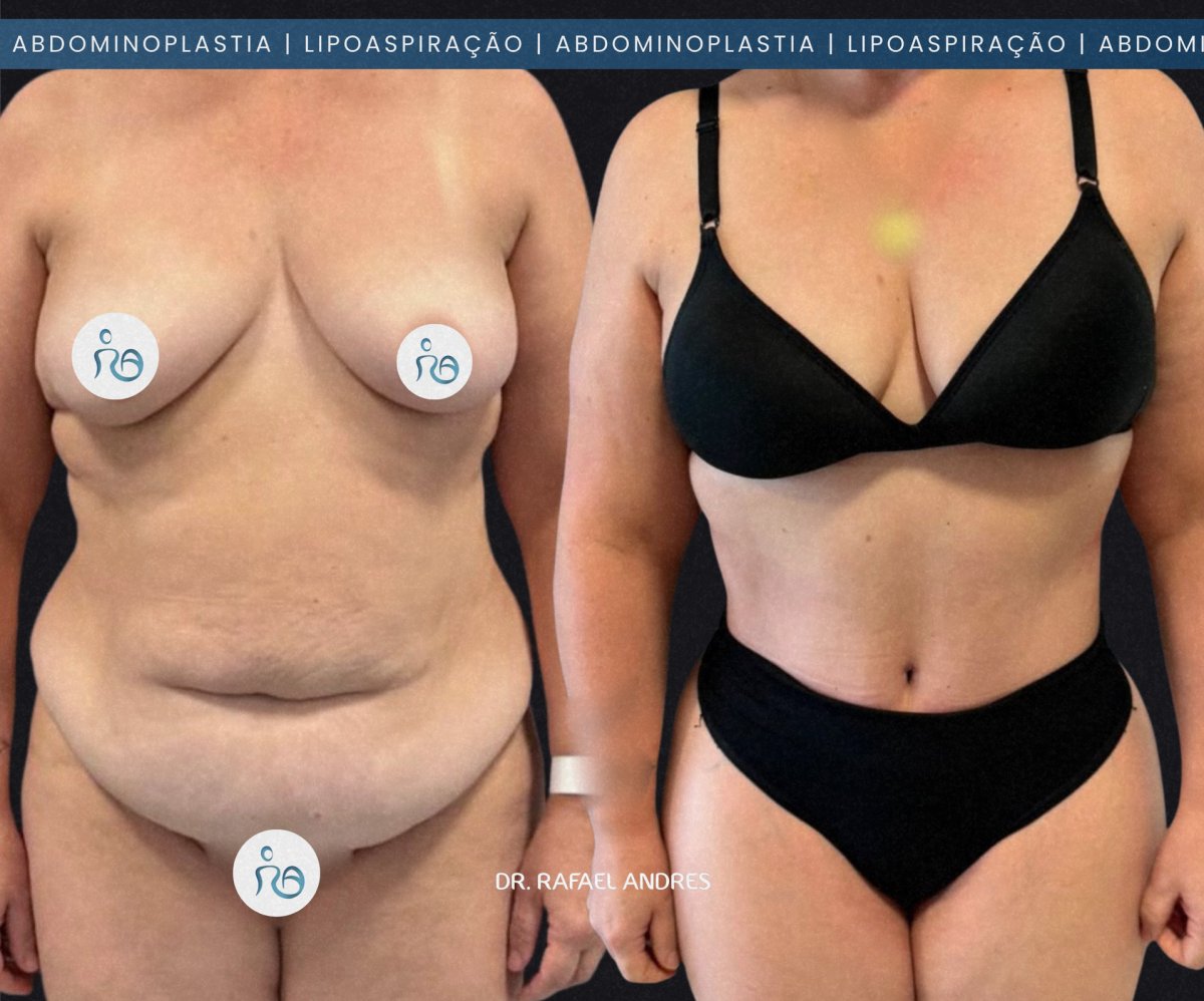 Resultados antes y después de liposucción y abdominoplastia con Dr. Rafael Andres, contorno corporal