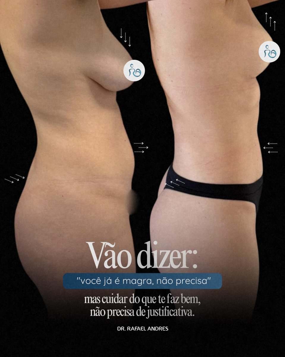 Resultados de liposucción antes y después – cintura definida y abdomen más plano