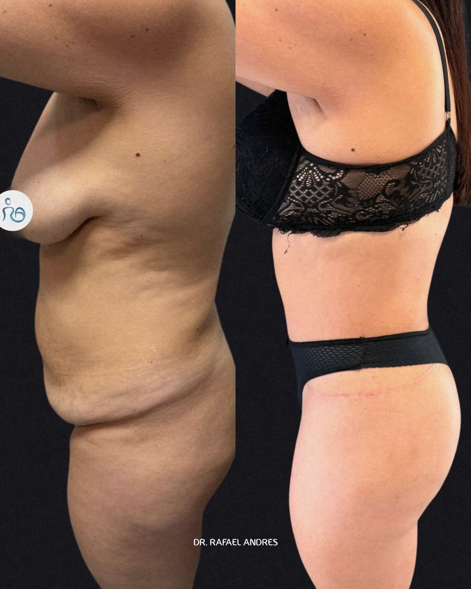 Resultados de liposucción antes y después en clínica Dr. Rafael Andres – mejor contorno abdominal