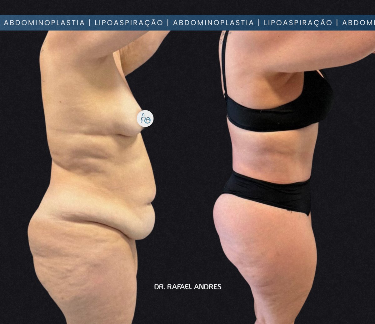 Resultados antes y después de liposucción y abdominoplastia con Dr. Rafael Andres, contorno corporal