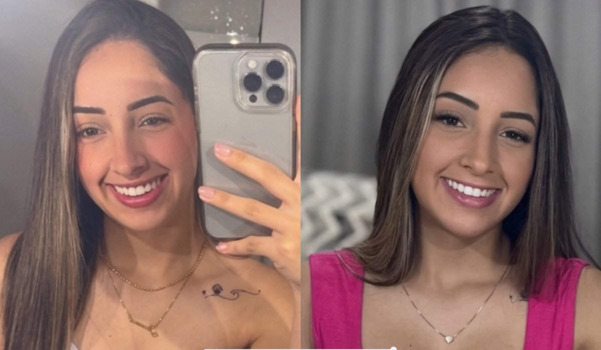 Resultados antes y después de carillas dentales: sonrisa más brillante y uniforme