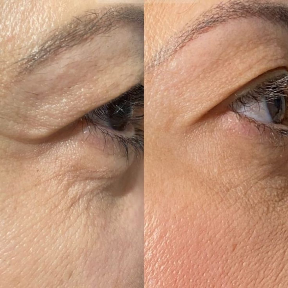 Before and after blepharoplasty results – eyelid correction with smoother skin