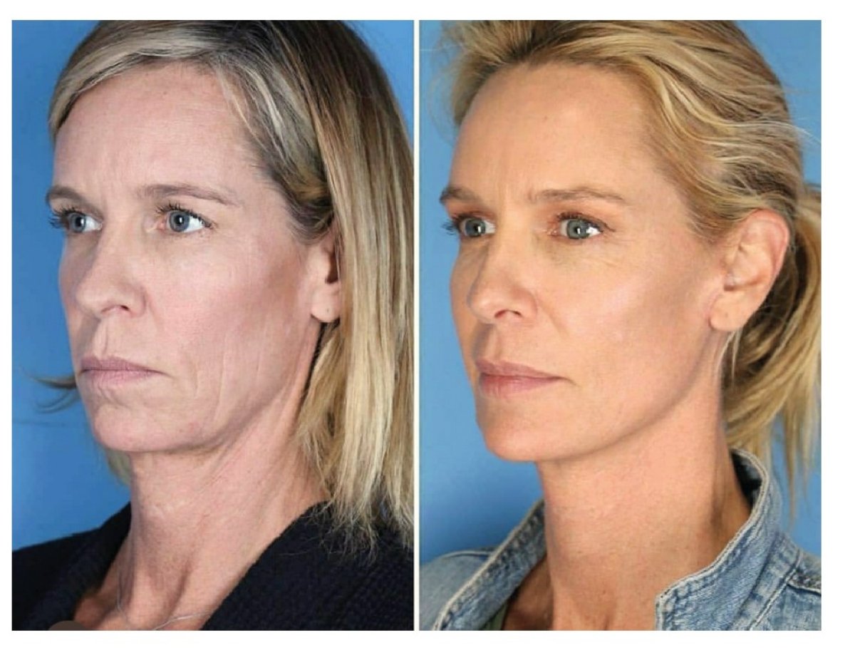 Facelift before and after results – smoother skin and defined jawline improvement