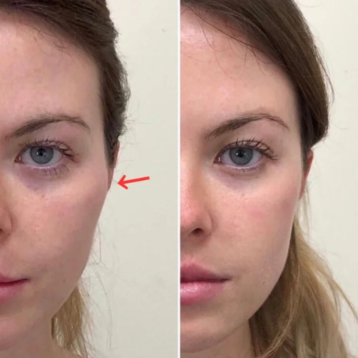 Before and after fillers injection result, enhanced cheek volume and contour improvement