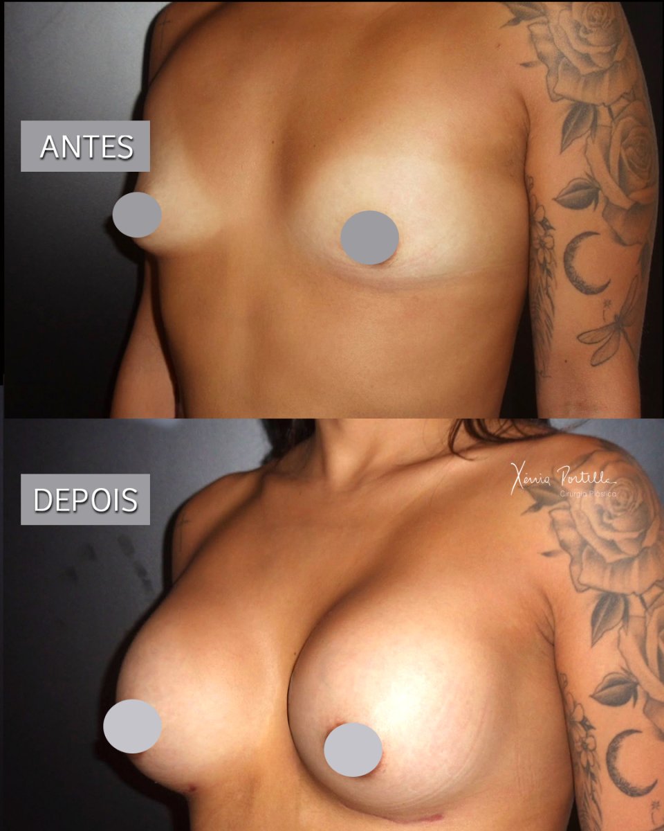 Before and after breast augmentation results – enhanced breast size and contour