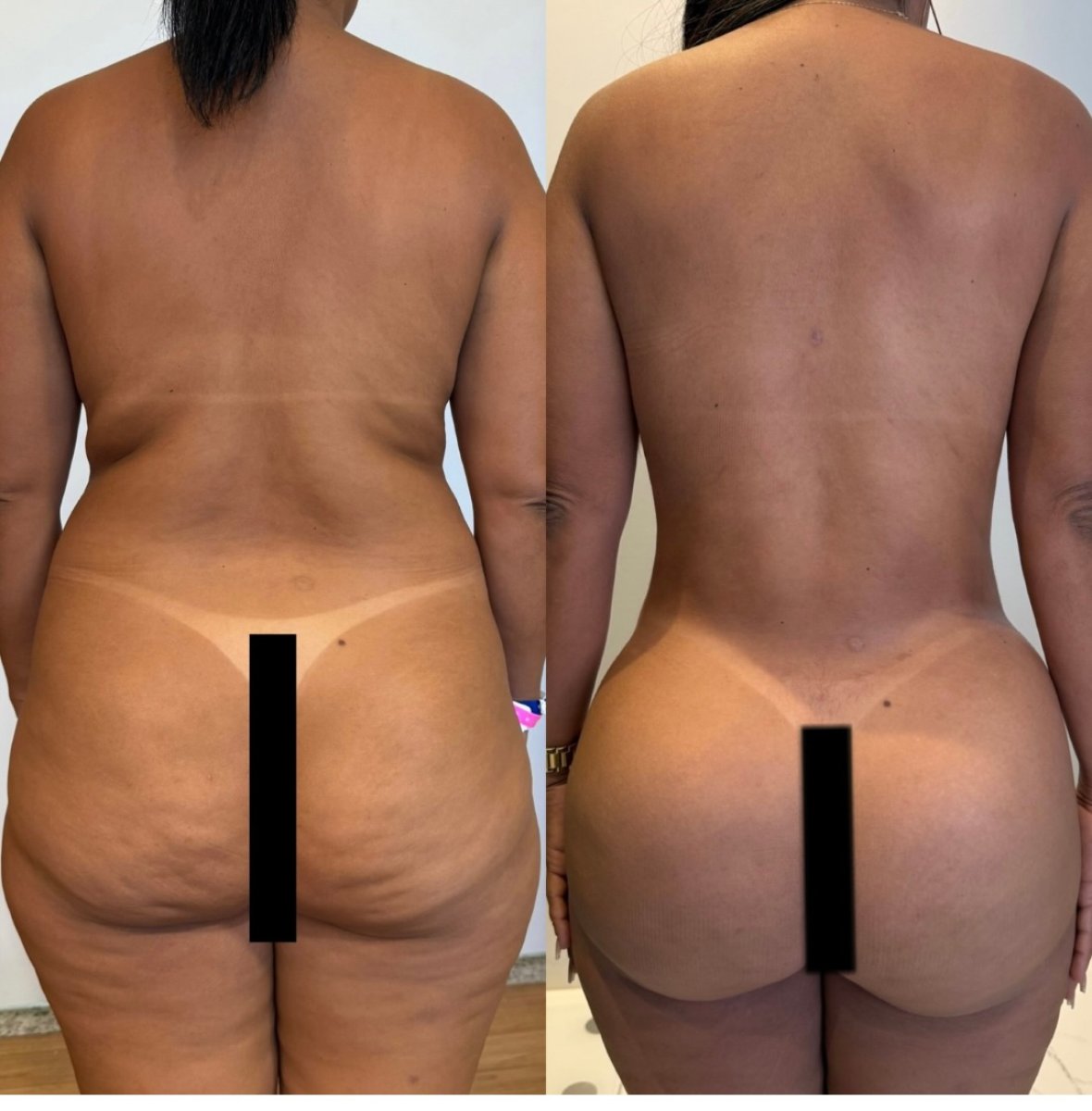 Efekty przed i po Brazilian Butt Lift – poprawiony kształt pośladków i talii