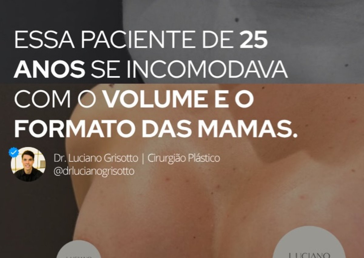 Breast augmentation result at Dr. Luciano Grisotto clinic – improved breast volume and shape