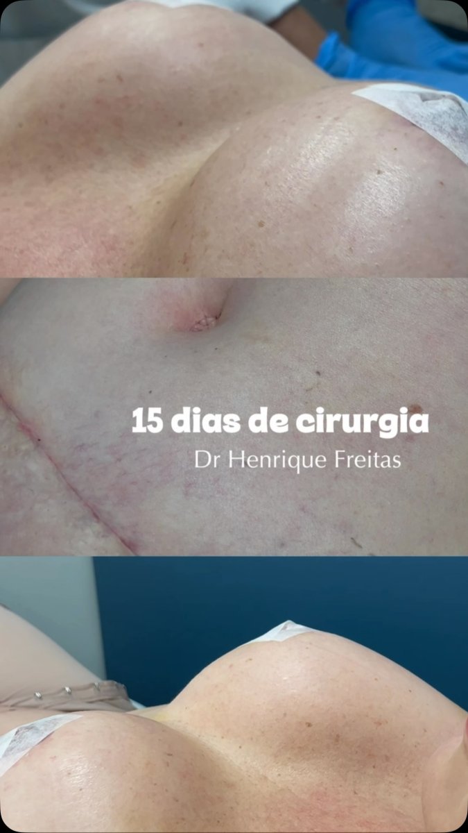 Breast augmentation results 15 days after surgery by Dr. Henrique Freitas, visible healing