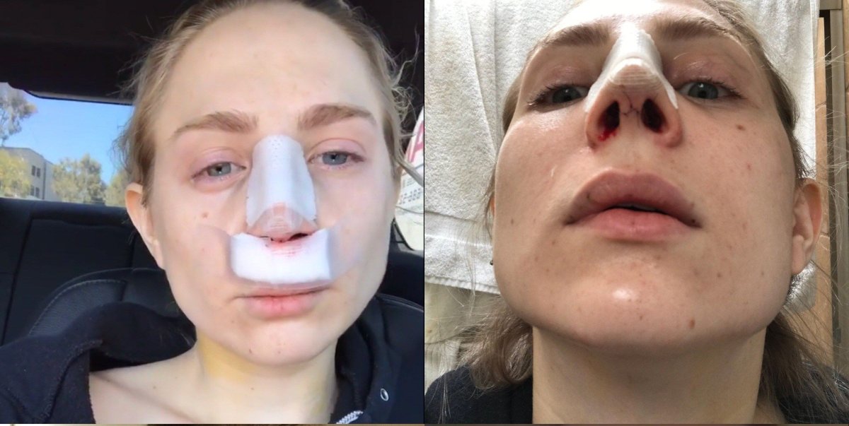 Early recovery after rhinoplasty procedure, nasal bandages and visible healing progress result
