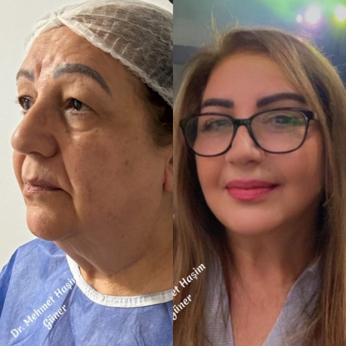 before and after photo