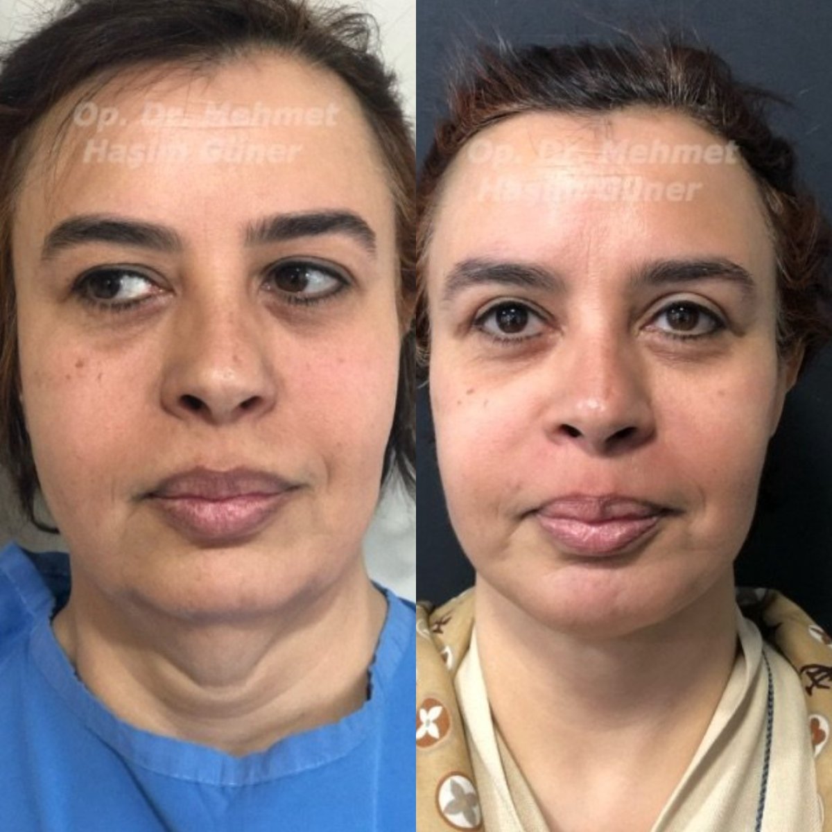 before and after photo