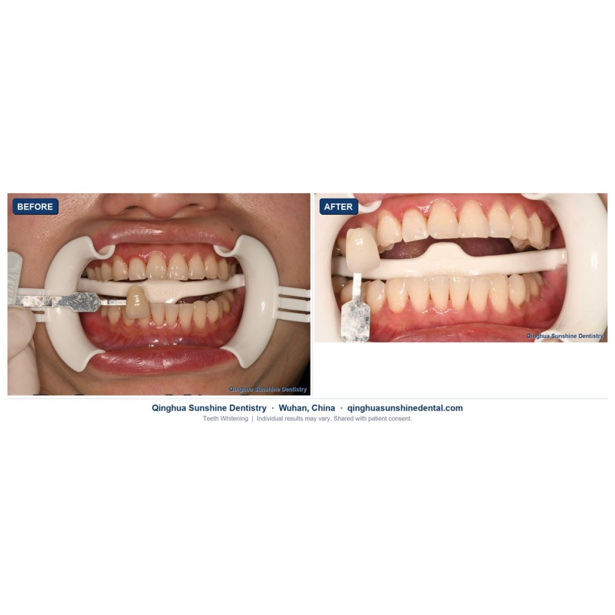 before and after photo