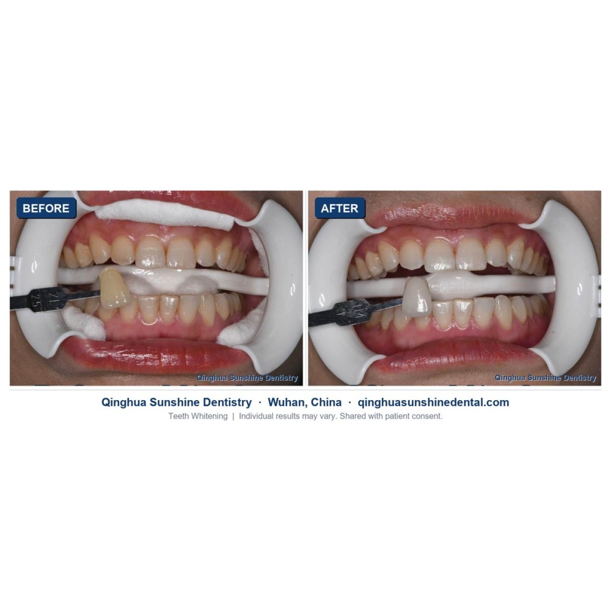 before and after photo