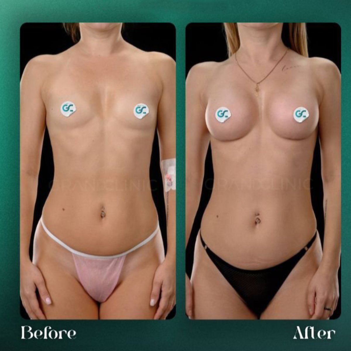 نتائج تكبير الثدي قبل وبعد في Grand Clinic – تحسين شكل الثدي