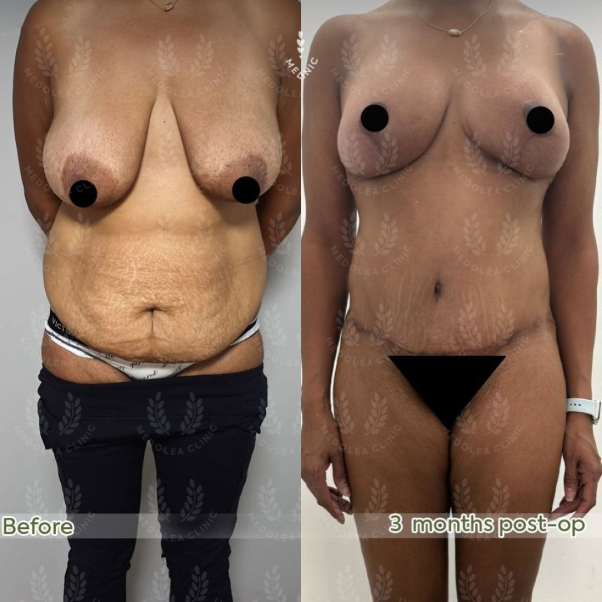 before and after photo