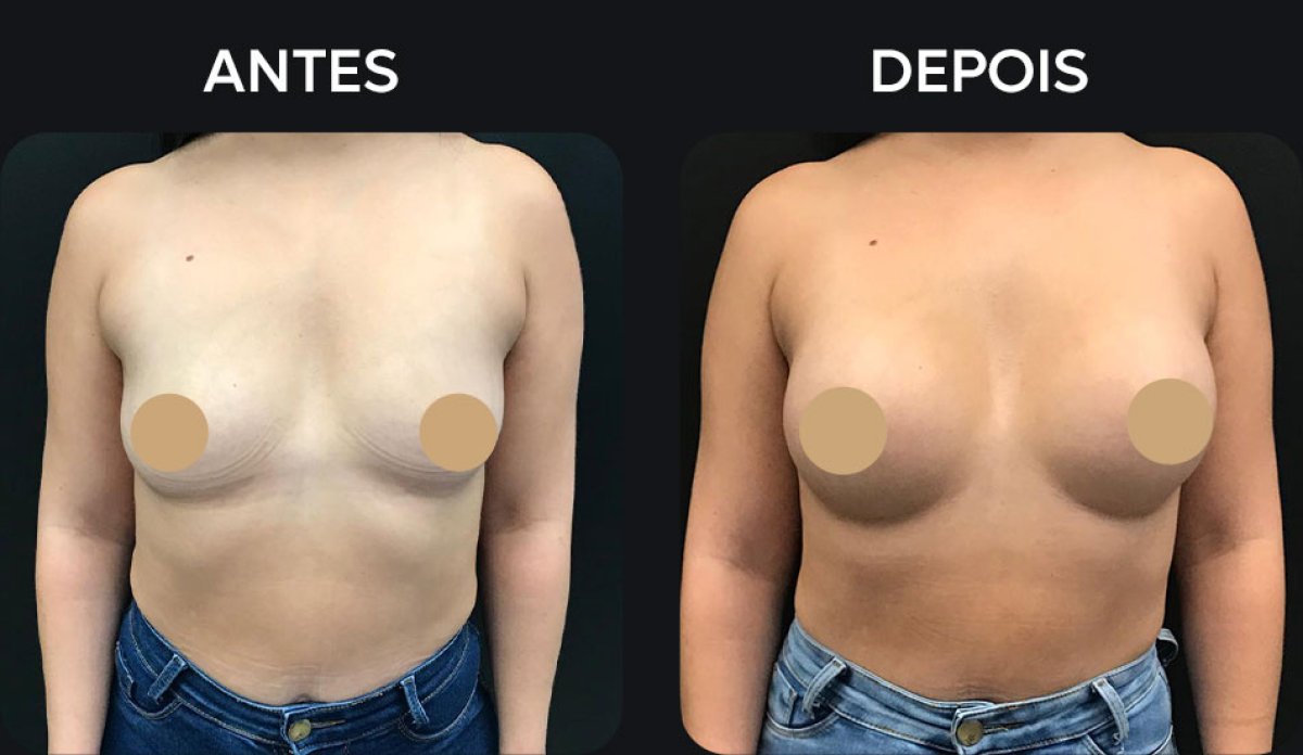 Before and after breast augmentation results – enhanced breast volume and contour