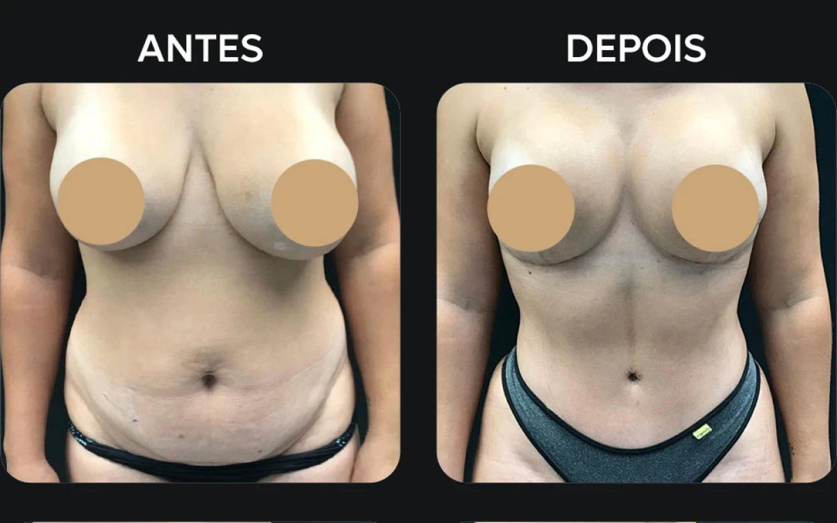 Before and after liposuction results – visible body contouring and abdomen slimming