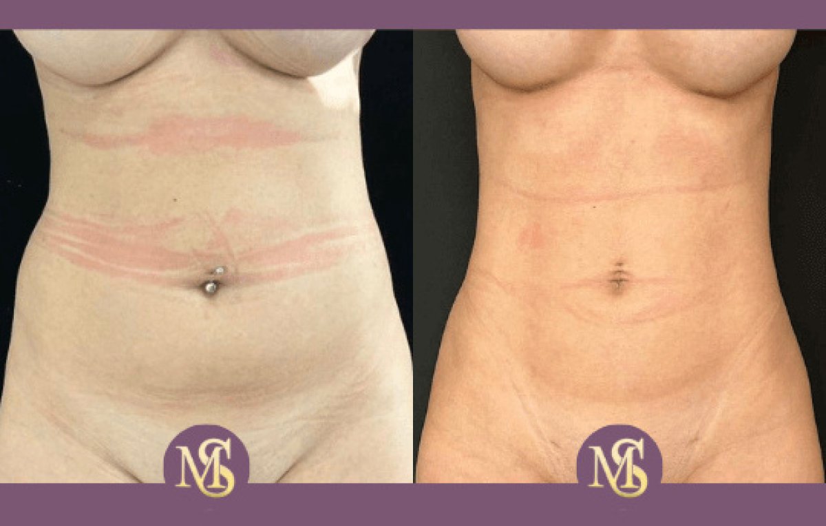 Resultados de liposucción antes y después en clínica MS – mejora del contorno de cintura