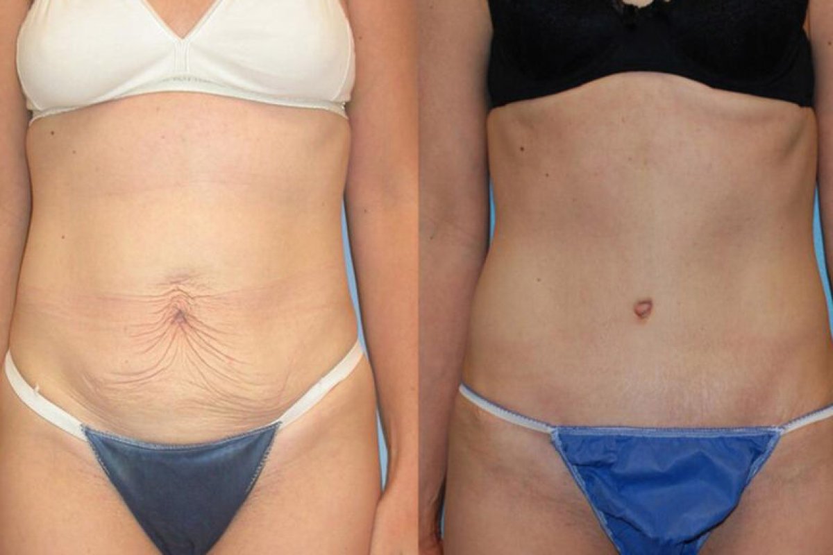 Before and after tummy tuck results – visible abdominal contour improvement and skin tightening