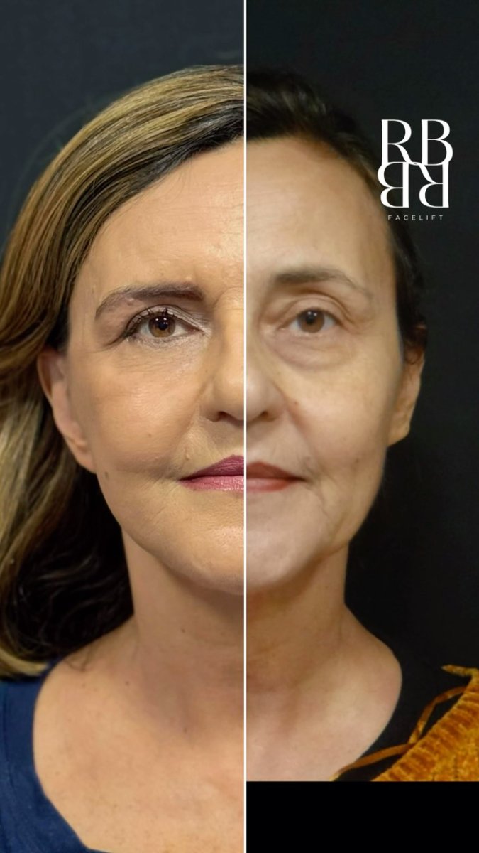 Before and after facelift results at RBB Facelift clinic – visible facial rejuvenation