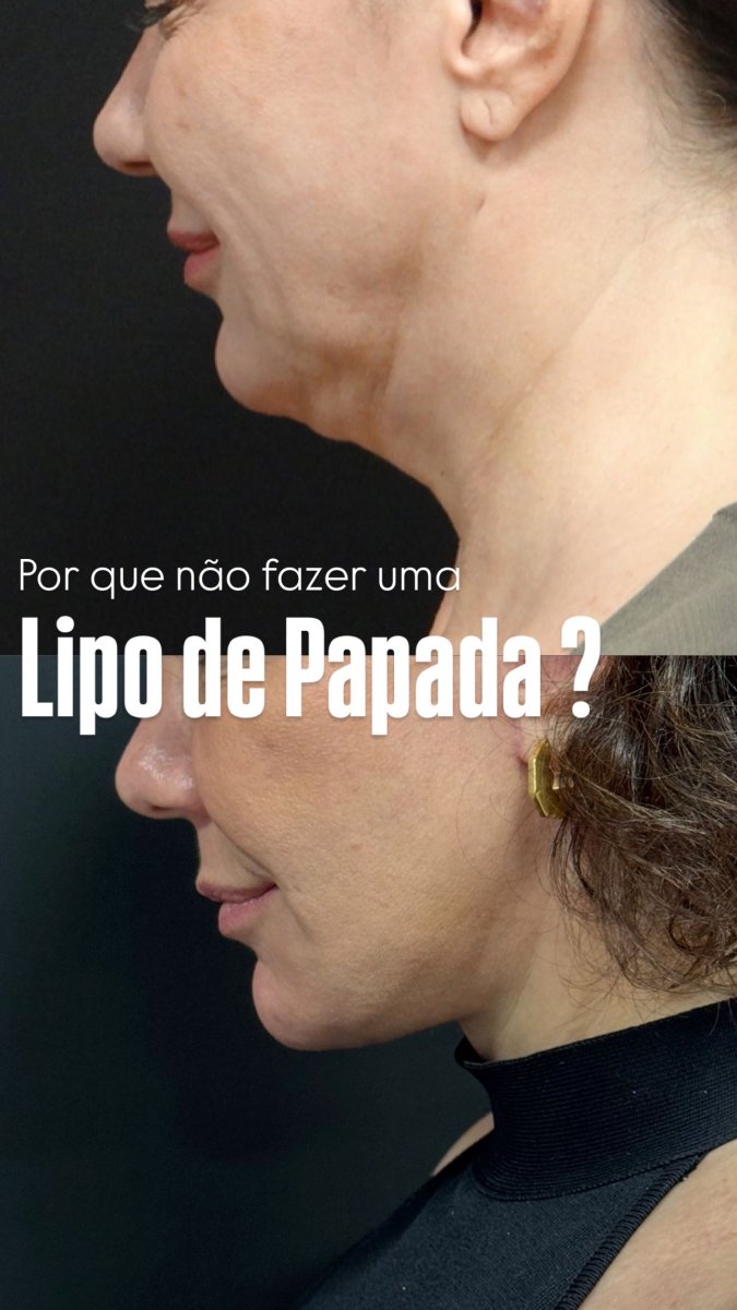 Before and after neck liposuction results – improved jawline and reduced double chin
