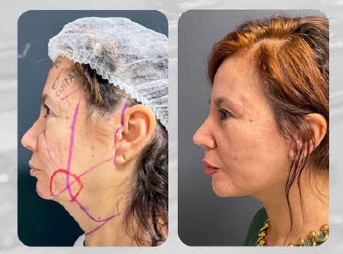 Facelift Vorher-Nachher-Ergebnis – sichtbare Verjüngung und straffere Kinnlinie