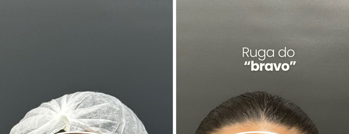 Botox wrinkle treatment before and after results – smoother forehead lines visible