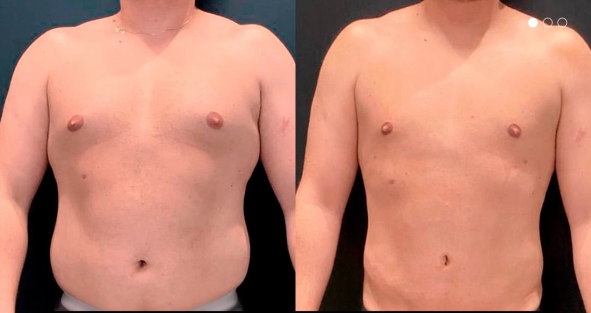 Before and after male liposuction results – visible chest and abdomen contour improvement
