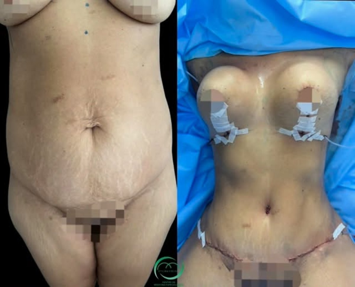Before and after breast lift and tummy tuck results – visible contour improvement
