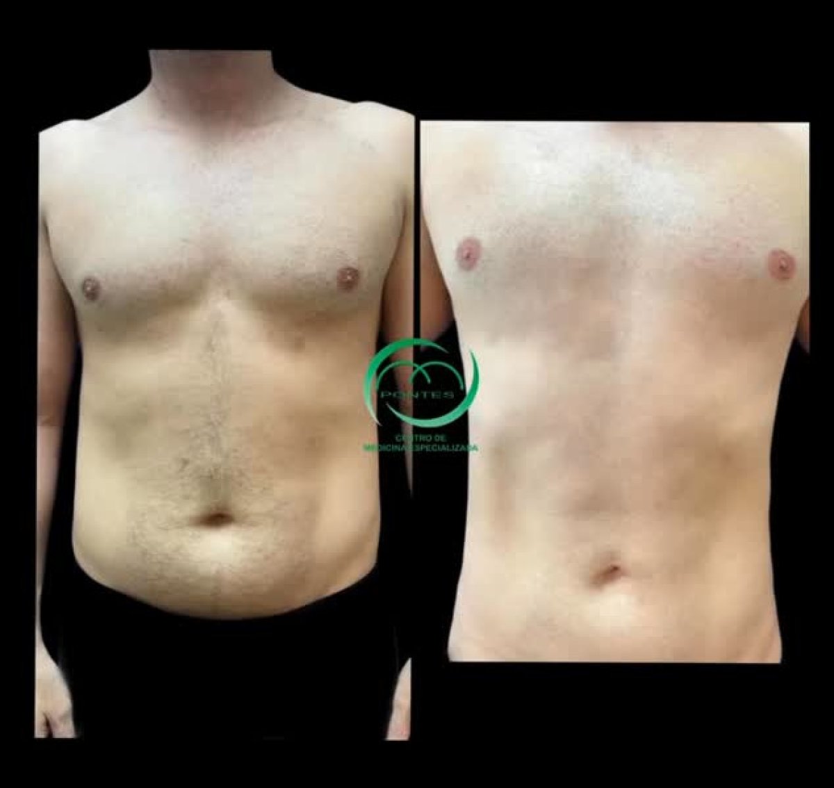 Before and after liposuction results at Pontes Clinic – visible abdominal contour improvement