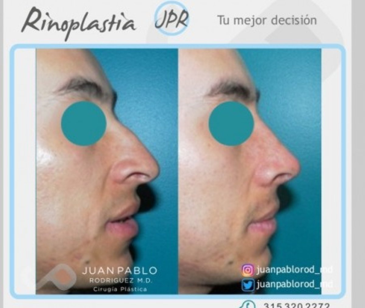Resultados de rinoplastia antes y después en clínica Juan Pablo Rodriguez, perfil nasal mejorado