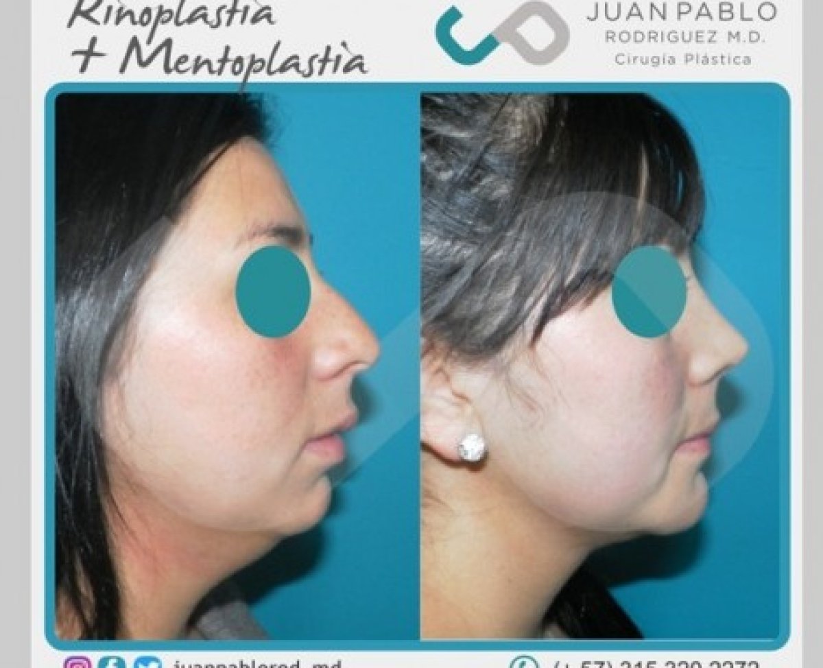 Resultados antes y después de rinoplastia y mentoplastia en clínica Juan Pablo Rodriguez