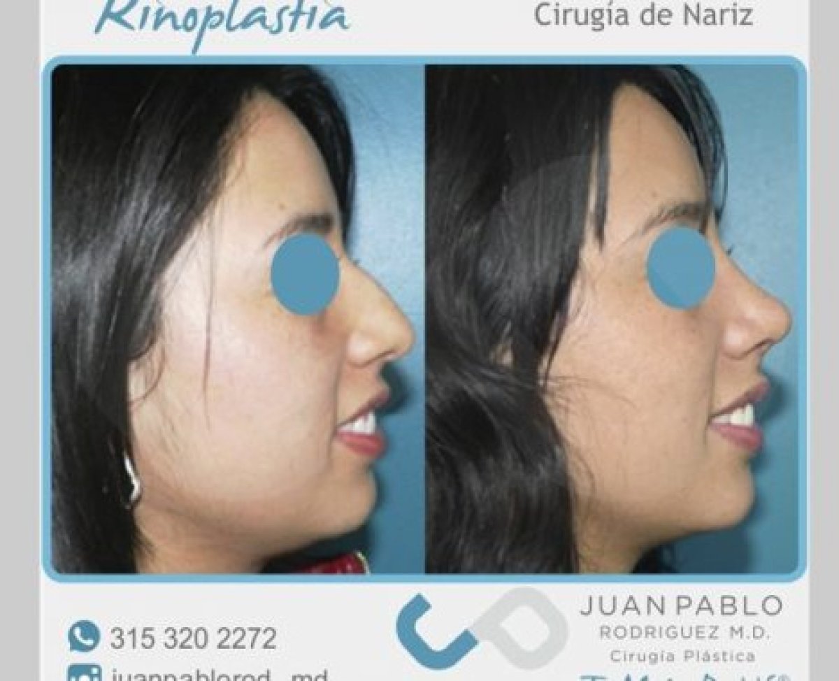 Resultados de rinoplastia antes y después en clínica Juan Pablo Rodriguez, remodelación nasal