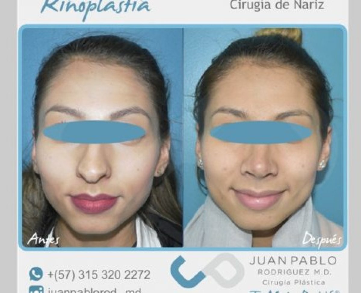 Resultados de rinoplastia antes y después en la clínica Juan Pablo Rodriguez, remodelación nasal
