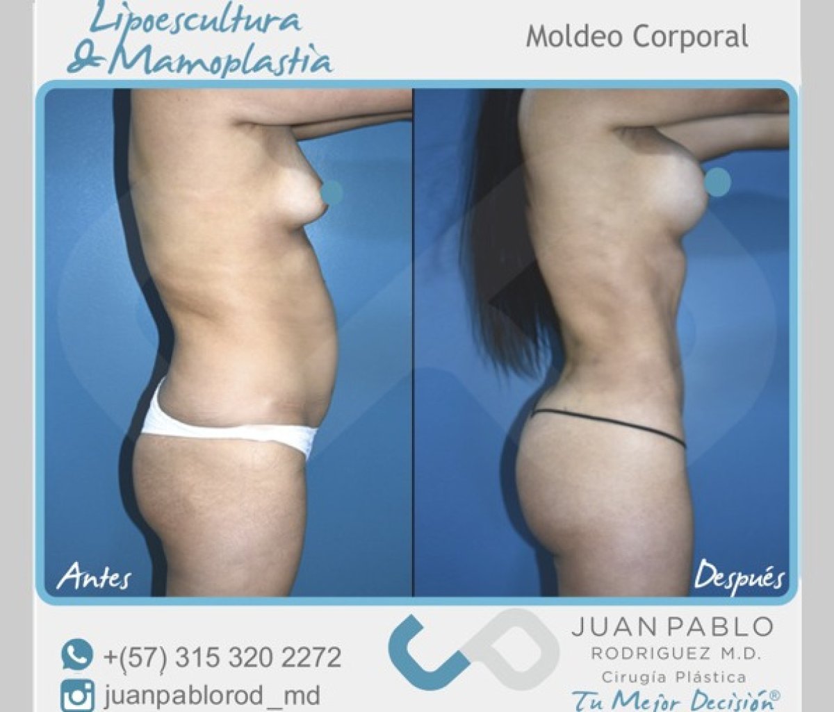 Resultados antes y después de lipoescultura y mamoplastia en clínica Juan Pablo Rodríguez