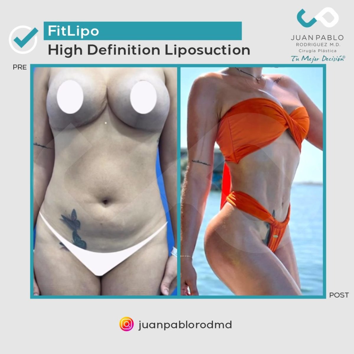 Resultados de liposucción de alta definición antes y después en clínica Juan Pablo Rodriguez
