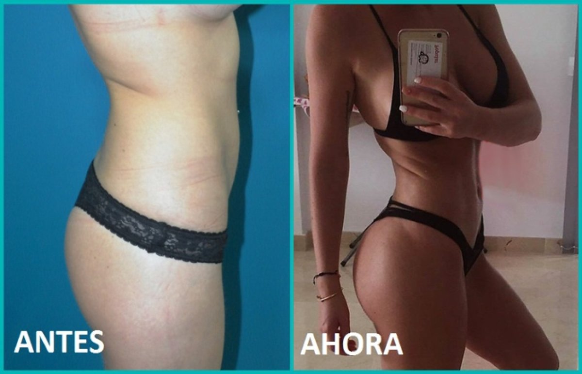 Resultados de liposucción antes y después – mejora del contorno de cintura y abdomen