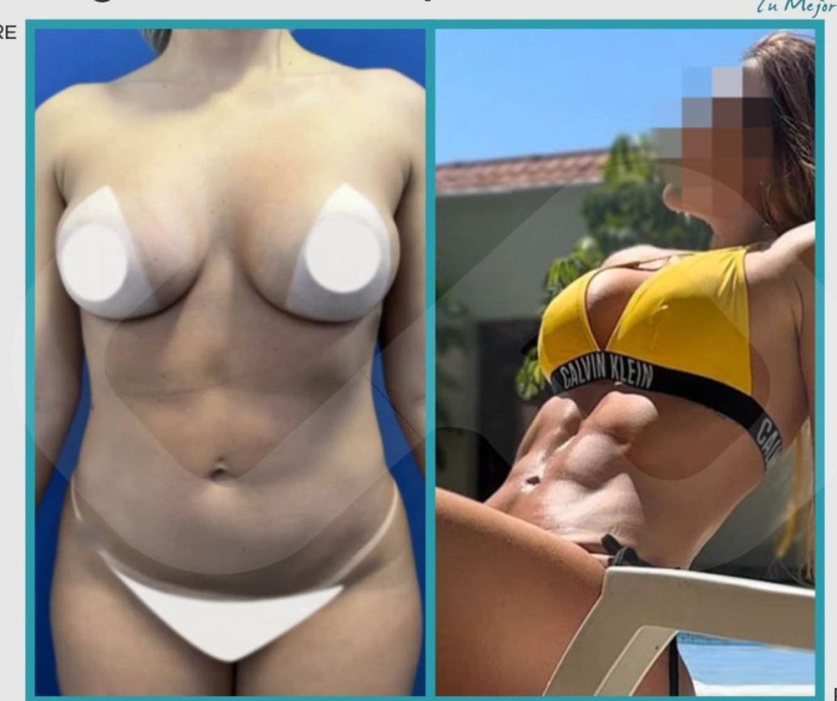 Resultados de liposucción antes y después – contorno corporal y abdomen definidos