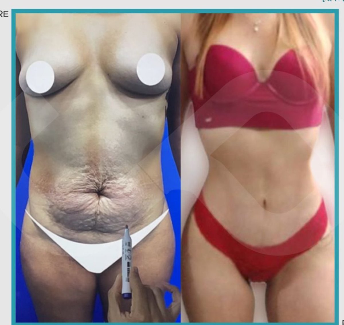 Resultados de abdominoplastia antes y después – mejora visible del contorno abdominal