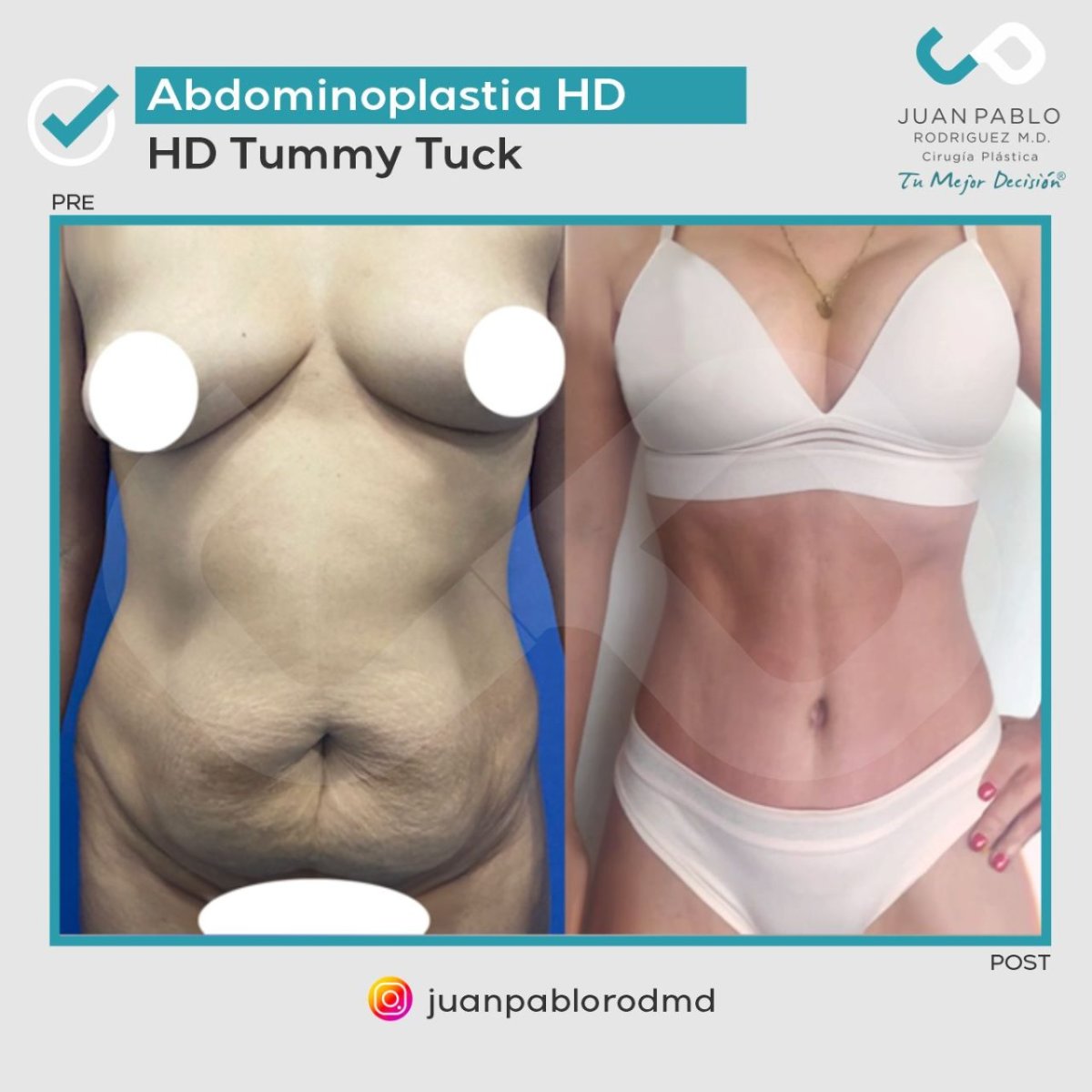 Resultados antes y después de abdominoplastia HD en clínica Juan Pablo Rodriguez – abdomen plano