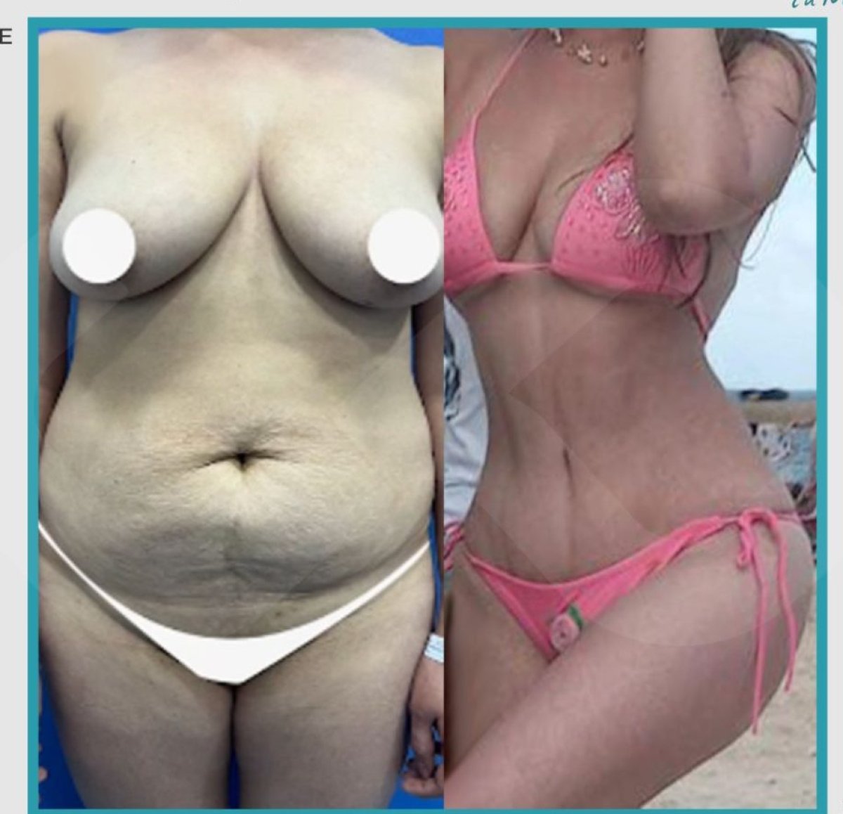 Resultados de abdominoplastia antes y después – mejora visible del contorno abdominal