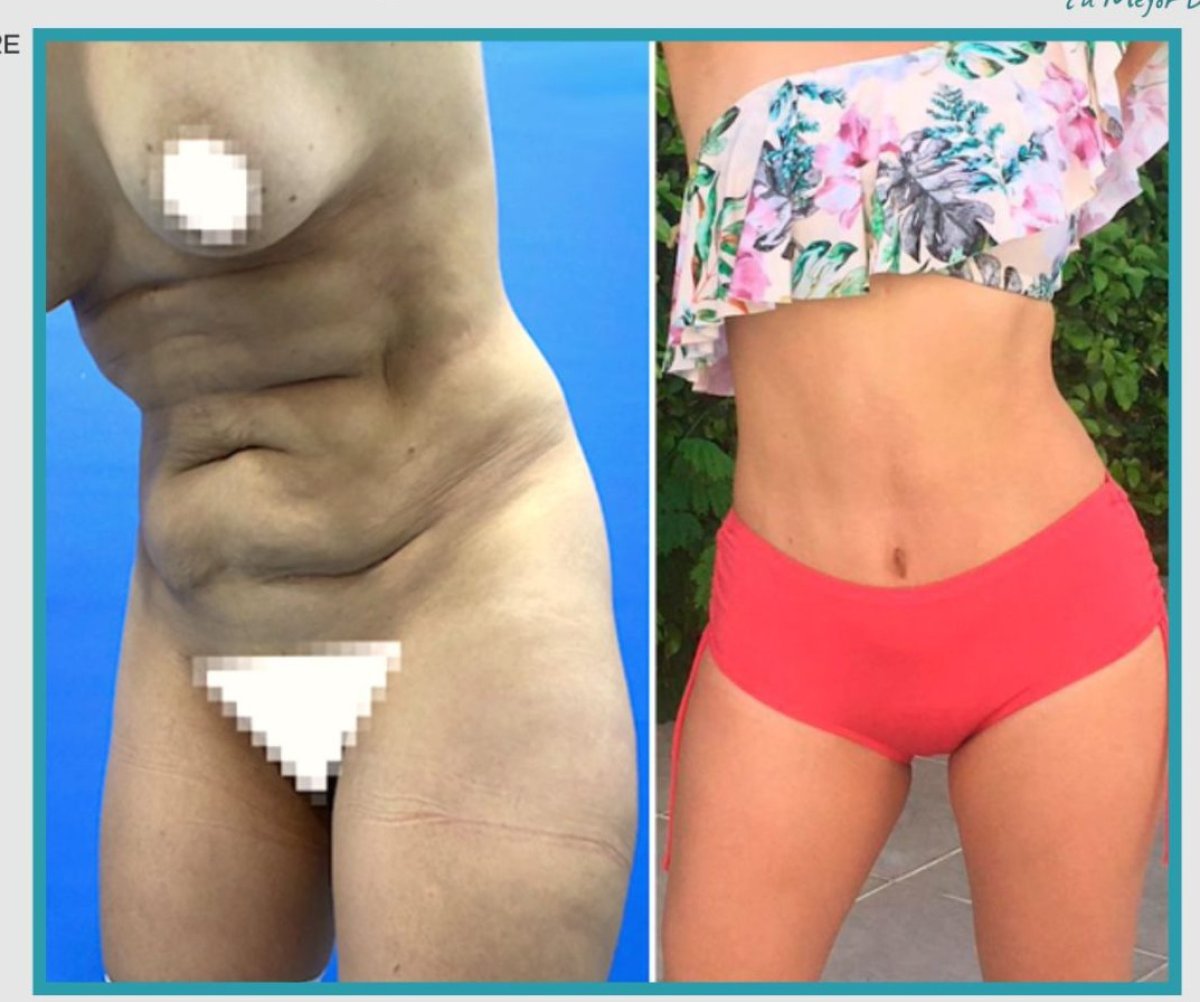 Resultados de abdominoplastia antes y después – mejora visible del abdomen en la clínica