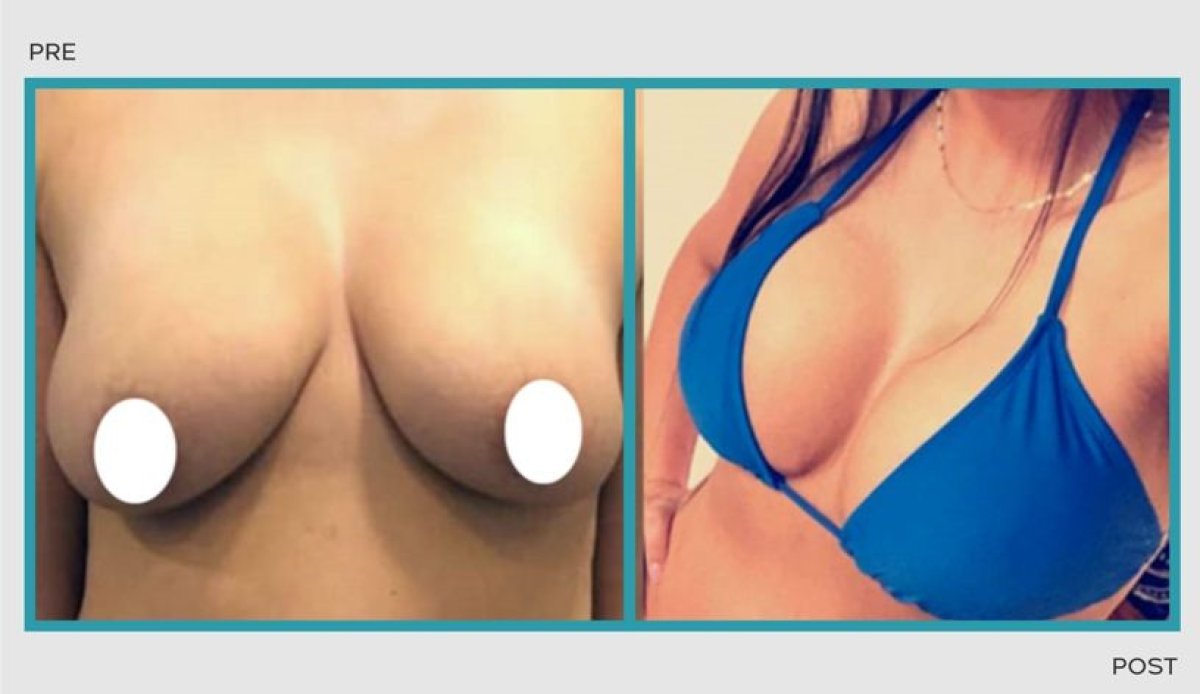 Resultados de antes y después de lifting de senos: mejor forma y contorno tras el procedimiento